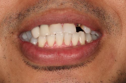 Crown came off with a broken tooth.